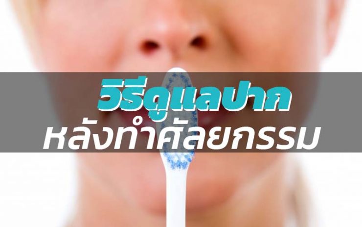 หลังศัลยกรรมปาก