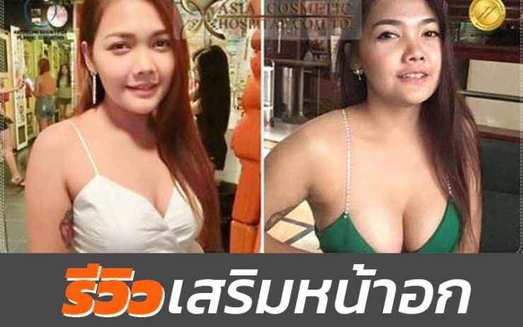 รีวิวเสริมอก